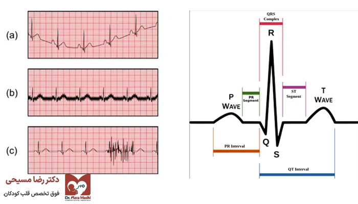 تفسیر کردن نوار قلب