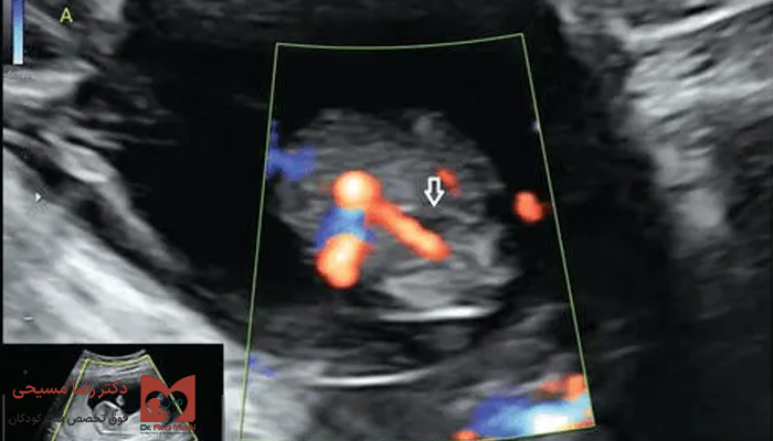 ناف تک شریانی در اکو