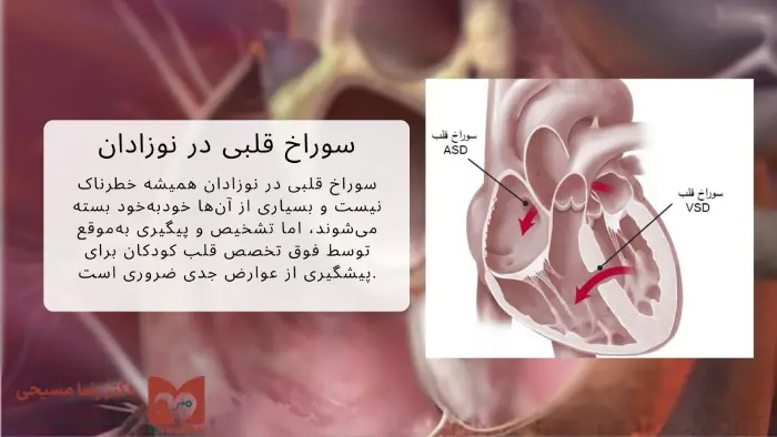 سوراخ قلبی در نوزادان