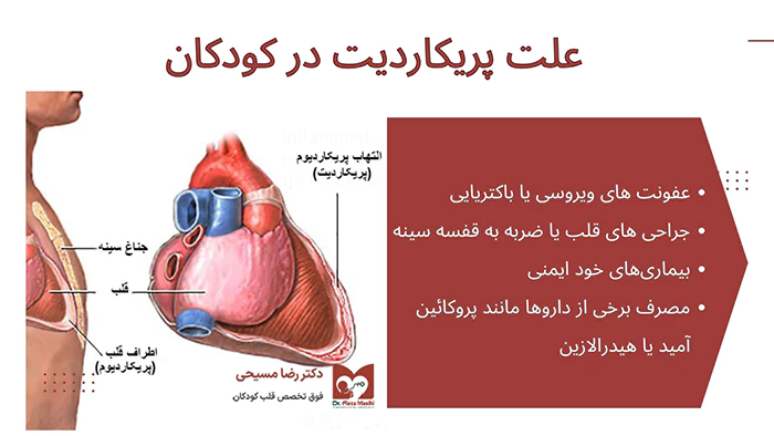 علت پریکاردیت در کودکان
